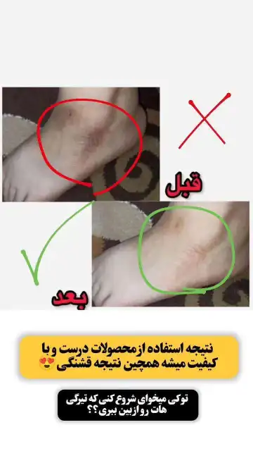 کرم رفع تیرگی بدن
